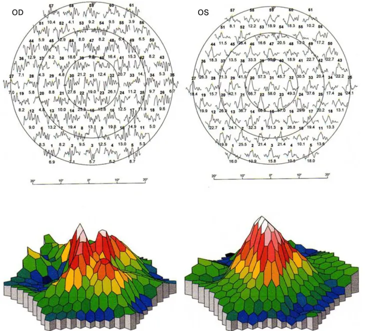 Fig. 2. Multifocal ERG; trace arrays and 3D-topography ofthe response density in the right eye shows prominent suppression of the central sig- sig-nal compared with that of the left eye.