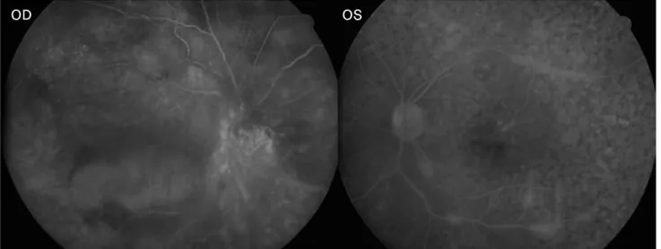 Fig. 3. Fluorescein angiography shows a granular pattern and leakage from vessels in the left eye.