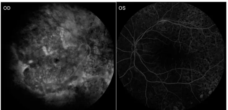 Fig. 6. Fluorescein angiography shows a persistent granular pattern but no dye leakage.