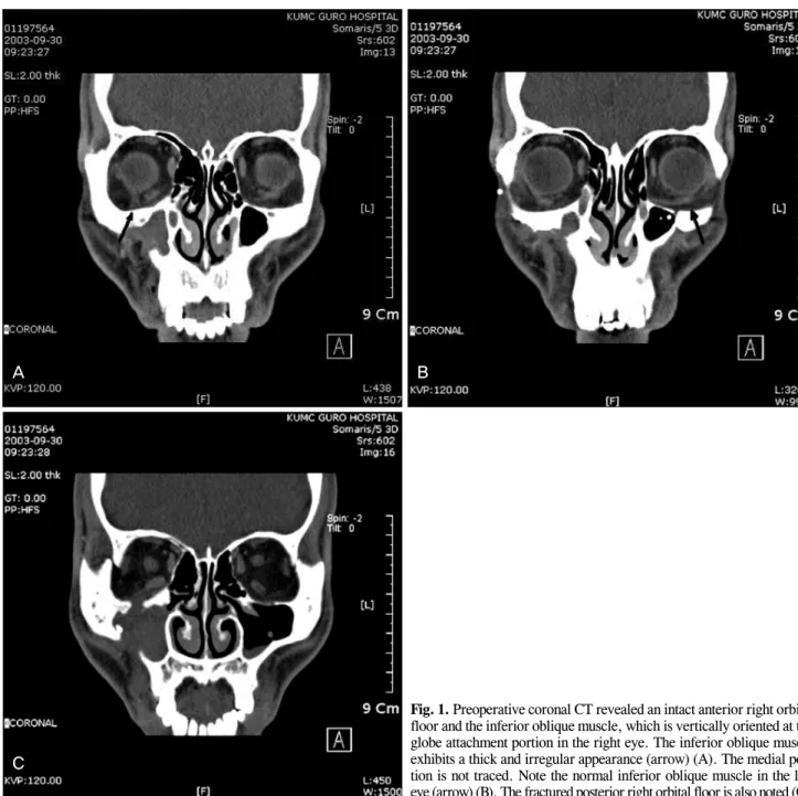 Fig. 1. Preoperative coronal CT revealed an intact anterior right orbital floor and the inferior oblique muscle, which is vertically oriented at the globe attachment portion in the right eye