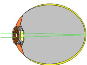 Fig. 2. Silicone oil droplets adhere to an intraocular lens   in  the lateral gaze.