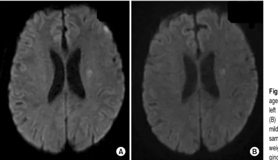 Fig. 2. (A) A preoperative DWI im- im-age showed acute infarctions in the  left frontal cortex and corona radiata