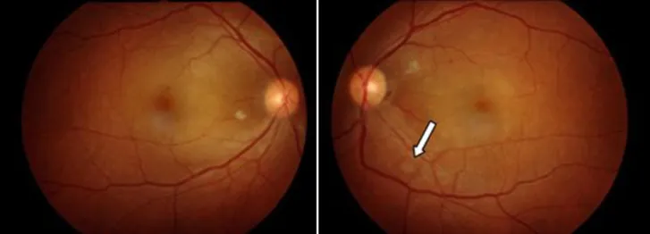 Fig. 1. Initial presentation. Fundus photo of both eyes showing exudative retinal detachment
