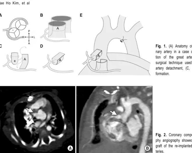 Fig. 1. (A) Anatomy of single coro- coro-nary artery in a case of  d-transposi-tion of the great arteries and (B)  surgical technique used for coronary  artery detachment, (C, D) tube graft  formation.