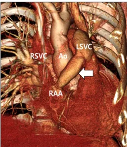 Fig. 2. Postoperative computed tomographic angiogram performed  one month after heart transplantation demonstrated a patent  con-duit interconnected between the left superior vena cava and right  atrial appendage (arrow)