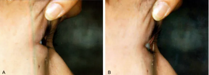 Fig. 2. Side view of the right eye shows. (A) A slight enophthalmos in the primary position