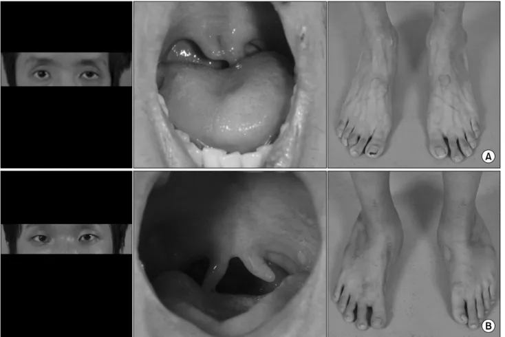 Fig. 1. Characteristic phenotypic findings in (A) case 1 and (B) case 2.