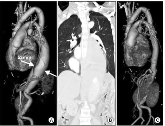 Fig. 2. Computed tomography imag- imag-ing of case 1. (A) 13 months before  surgery, (B) at the time of rupture,  and (C) postoperatively.