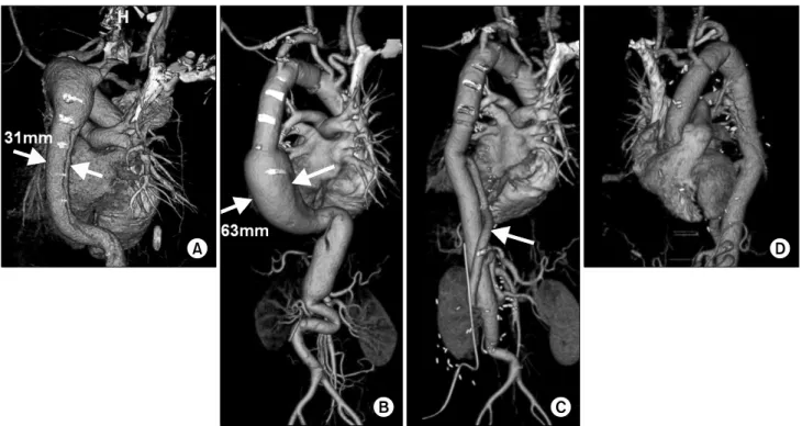 Fig. 3. Computed tomography (CT) imaging of case 2 (A) before the first operation, (B) six months after the first operation
