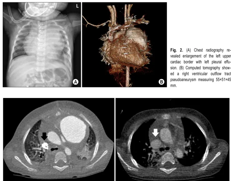 Fig. 3. Computed tomography showed a narrowed superior vena cava compared with the previous image.