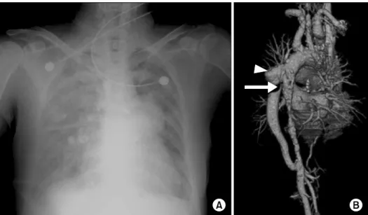 Fig. 1. Chest radiograph and computed tomography scan before the stent graft procedure