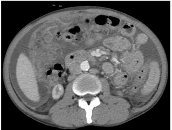 Fig. 1. Chest  radiograph  shows  pleural  effusion  in  both  lung  fields.