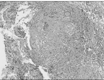 Fig. 4. Chronic granulomatous inflammation consistent with tu- tu-berculous  peritonitis  was  showed  in  biopsy  of  peritoneum  (HE  stain,  ×400).