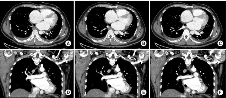 Fig. 1. (A-C) Axial and (D-F) coronal views of computed tomography imaging show a loculated air density on the right side of the left  atrium.