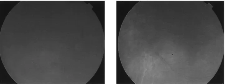 Fig.  4.  Fluorescein  angrography  on  the  day  after  initial  presentation:  (Left)  Right  eye  (Right)  left  eye,  at  late  phase