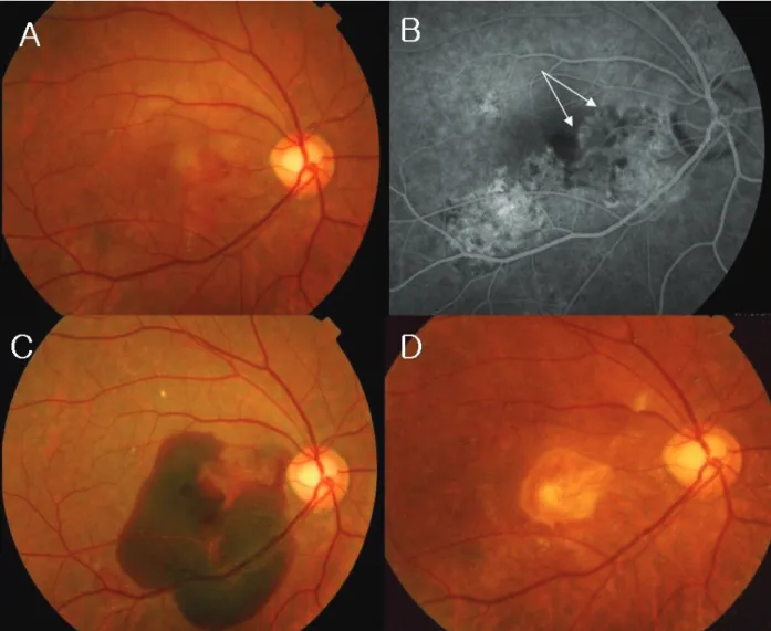 Fig. 1. Case 4, with exudative maculopathy in the right eye. (A) Fundus photograph showing subretinal blood and subretinal serous  detachment