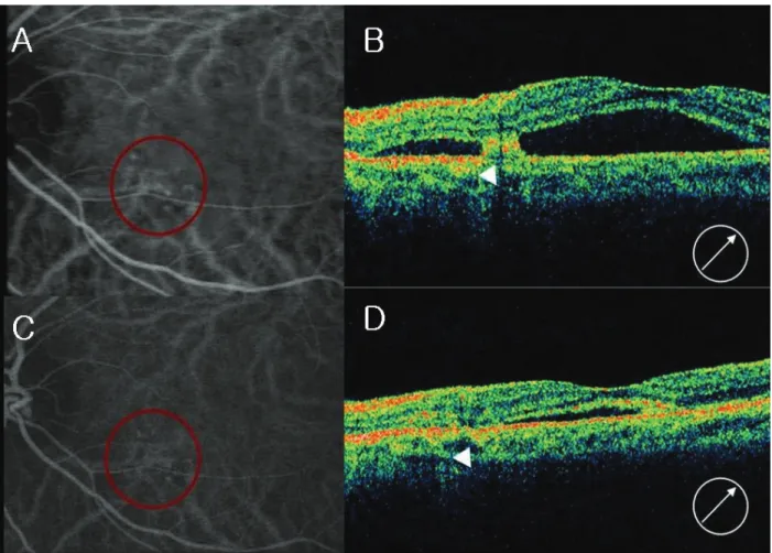 Fig. 2. Case 3, left eye, the fellow eye of the case 4 patient (Fig. 1). (A) Midphase indocyanine green angiogram (ICGA), showing  multiple polypoidal dilations of choroidal vessels and an interconnecting network
