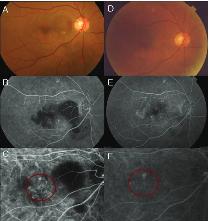 Fig. 3. Case 8 with persistent active polypoidal choroidal vasculopathy (PCV) 4 months after photodynamic therapy (PDT)