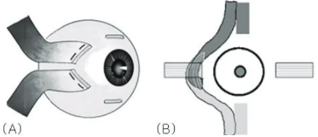 Fig. 1. The method of surgery used in this study. (A)  Diagram of the full thickness vertical muscle transposition  toward medial rectus muscle in patients 1 and 2