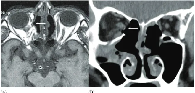 Fig. 3. Patient 1. Orbital computerized tomography after endoscopic sinus surgery. (A) Axial view (B) Coronal view