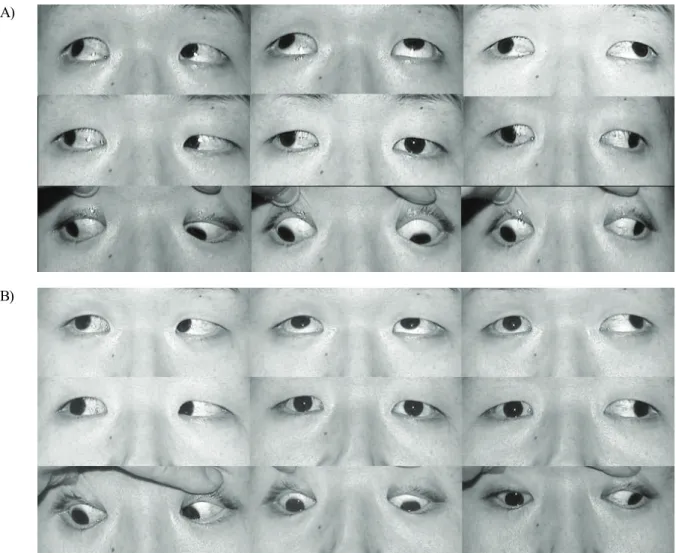 Fig. 4. Patient 3. (A) Preoperatively, fixed large‐angle exotropia of 85△  and absent adduction (‐7 limitation) of his right eye