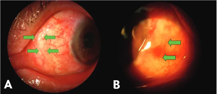 Fig. 4. (A) Mild shrinkage (between arrows) of the conjunctivolimbal autograft and recipient conjunctiva was noted 2 weeks after  surgery: Secondary epithelialization and spontaneous closure of the wound gap occurred in one week