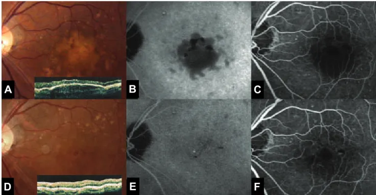 Fig. 2. (A) Fifteen days after PDT, there was no interval change, on the fundus examination