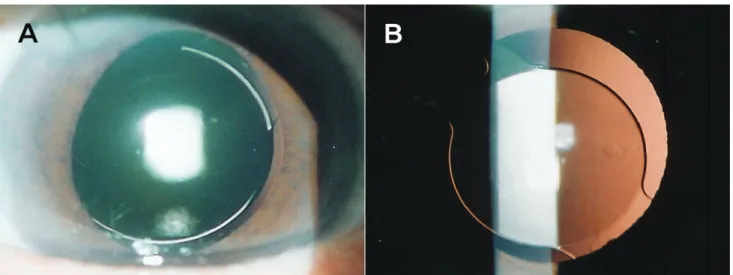 Fig. 5. Slit-lamp examination at 1 week after surgery. (A) A well-centered IOL. (B) An IOL slightly decentered in an inferior  direction.