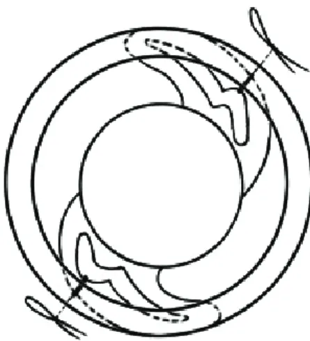Fig. 6. The broad arc of distal haptic-tissue contact in the  two-point suture fixation technique.