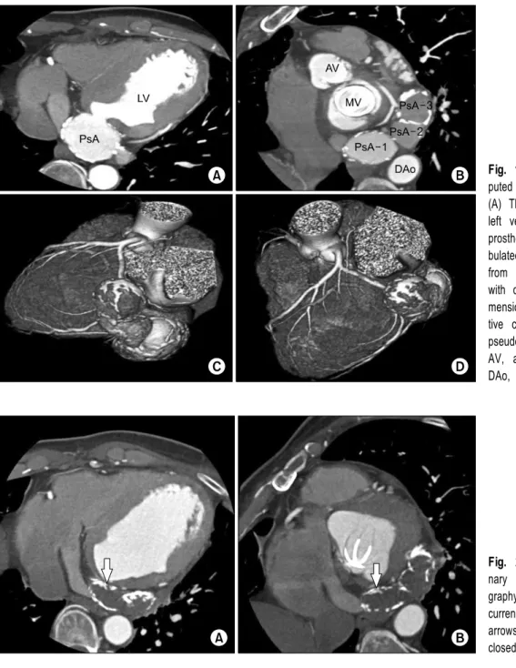 Fig. 1. Preoperative coronary com- com-puted tomography (CT) angiography. 