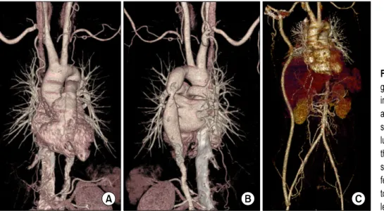 Fig. 1. Preoperative computed tomo- tomo-graphy angiotomo-graphy. (A) The  ascend-ing aorta, aortic arch and supra  aortic arteries are relatively well  pre-served in anterior view