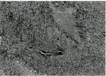 Fig . 4 . (H&amp;E, x100) Elongated tumor ce lls a re a rra nged in inte rwove n bundle s o r ha pha za rdly with s ca nty co lla ge nous stro ma .