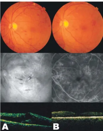 Table  2.  Foveal  thickness  measured  with  optical  coherence  tomography  in  the  combined  (panretinal  photocoagulation  and  intravitreal  injection  of  triamcinolone  acetonide)  treated  eyes  before  treatment  and  2  weeks,  1,  2,  3  months
