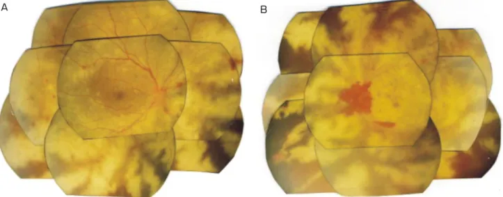 Fig.  2.  Subsequent  fundus  photographs  of  each  eye.  (A)  Extensive  deep  retinal  white  opacification  sparing  perivascular  area  is  visible