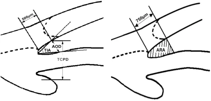 Fig.  1.  Schematic  representation  of  UBM  anterior  chamber  angle  measurement.  Angle  opening  distance  (AOD 500 )  is  defined  as  the  length  of  the  line  drawn  from  the  point  on  the  corneal  endothelial  surface  500  µm  anterior  to 