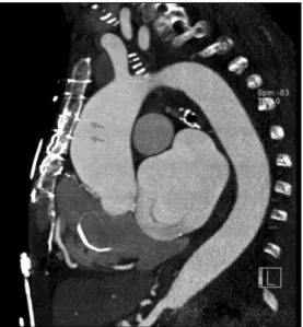 Fig. 2. Preoperative computed tomography scan showing sternal  wire erosion (arrows) into the aorta.
