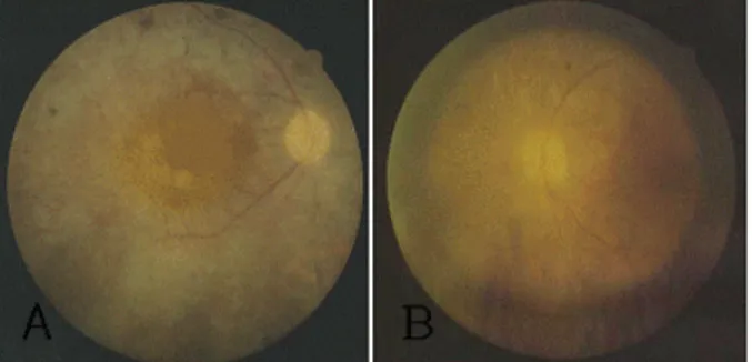 Fig.  2.  Visual  field  of  the  right  (A)  and  left  (B)  eye.  Extensive  peripheral  field  defect  is  noted  (central  10°)