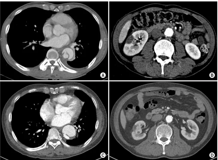 Fig. 1. (A) Initial preoperative computed tomography (CT) scan showing an acute DeBakey type IIIb aortic dissection with a maximum di- di-ameter of 36 mm