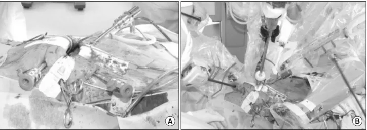 Fig. 1. Port placement for mitral valve repair surgery. (A) Four ports and a Chitwood transthoracic aortic cross clamp are in place before  aorta cross clamp
