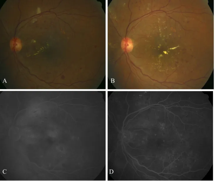 Fig.  3.  Preoperative  OCT  scan  (A)  shows  diffuse  macular  thickening  of  505  µm