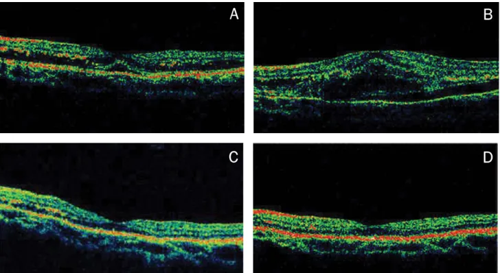 Fig.  2.  Optical  coherence  tomogram  images.  (A)  OCT  image  demonstrating  cystic  macular  edema  at  first  visit