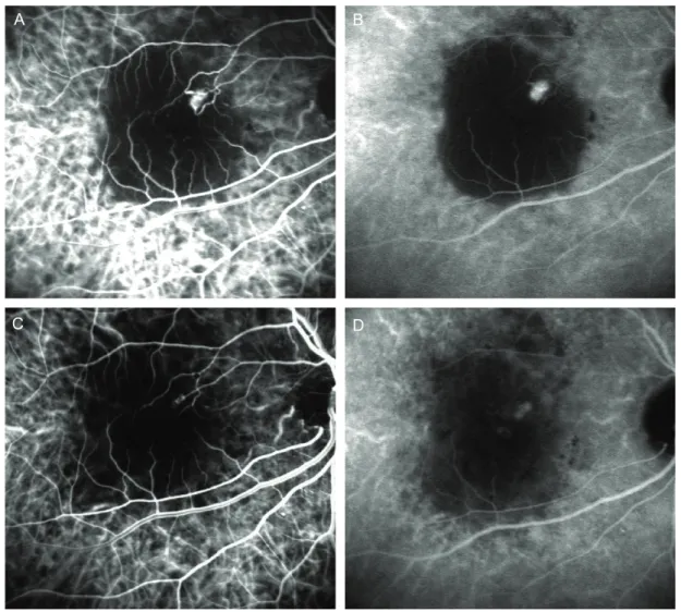 Fig. 1. Early and late phase indocyanine green angiogram (ICGA) of the right eye of the patient #2 shows focal area of hyperfluorescence and discrete rim of hypofluorescence due to retinal pigment epithelial detachment  before treatment (A, B)