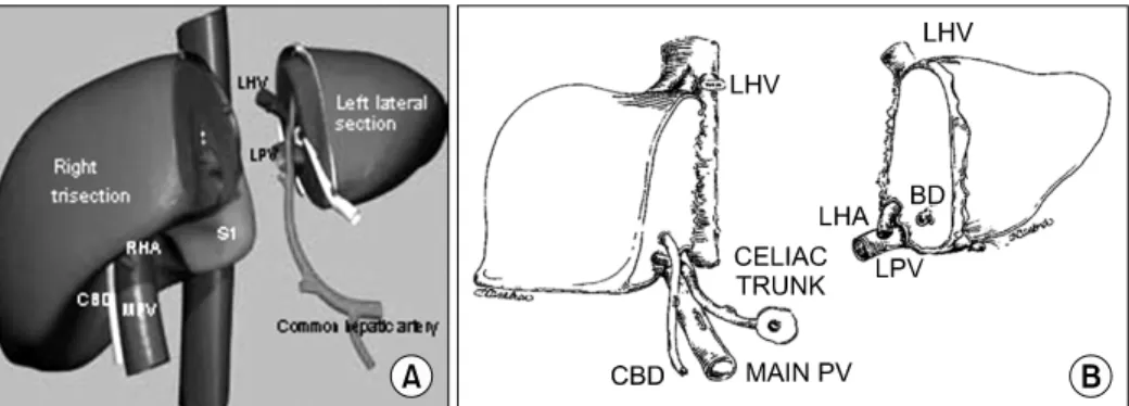 Fig. 3. Split  liver  transplantation  of  left  lateral  section  and  right  trisection