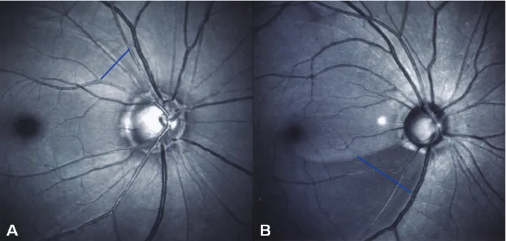 Fig. 5. Examples of interpretation of the retinal nerve fiber layer photographs using HRA1