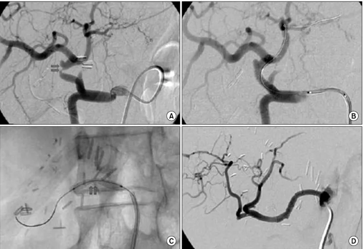Fig. 2. Hepatic angiography showing arterial kicking and stenosis. Hepatic angiography show arterial kicking and stenosis at the anas- anas-tomosis of CHA in CLT