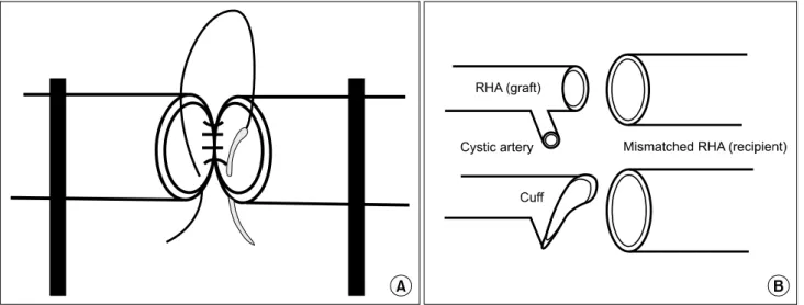 Fig. 3. Schematic drawing of the microvascular anastomosis. Schematic drawings show the microvascular anastomosis