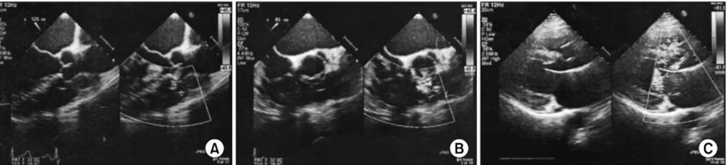 Fig. 3. A chest X-ray suggestive of the embolised device in the  left pulmonary artery
