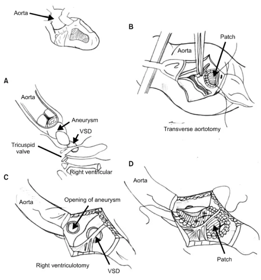 Fig. 5. Anatomical details of the  rupture of the sinus of Valsalva. VSD,  ventricular septal defect.