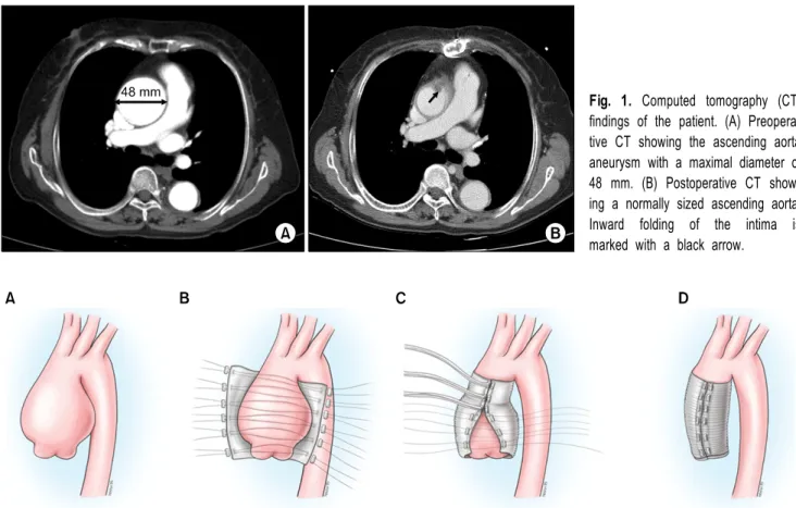 Fig. 1. Computed tomography (CT)  findings of the patient. (A)  Preopera-tive CT showing the ascending aorta  aneurysm with a maximal diameter of  48 mm