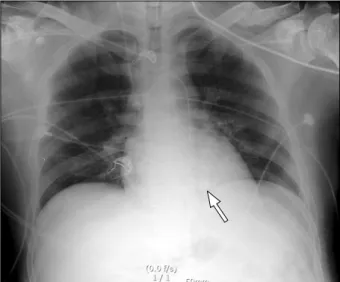 Fig. 2. (A) Chest radiograph show- show-ing severe pulmonary edema after  coronary stent insertion to the middle  segment of the left anterior  descend-ing coronary artery